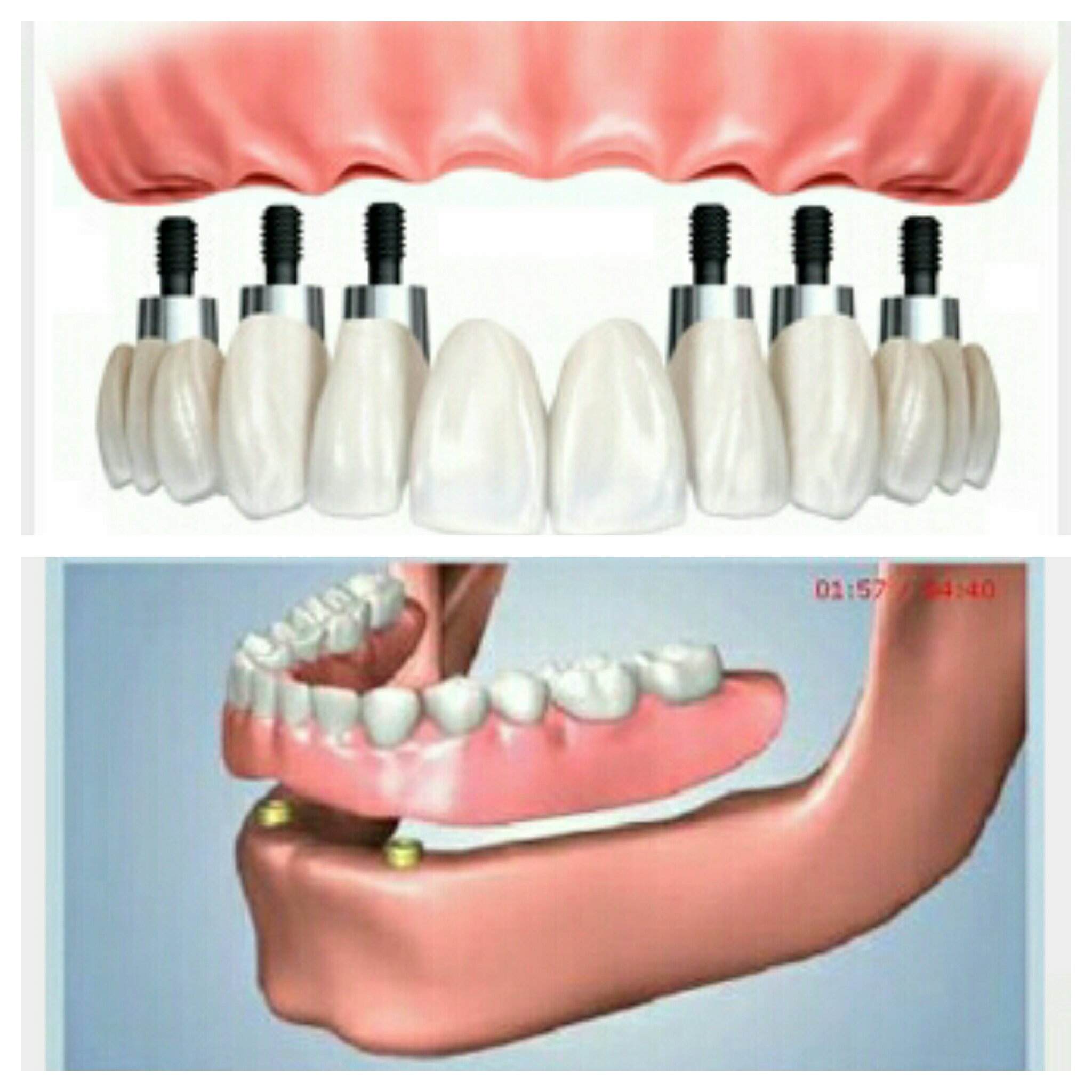 ایمپلنت پروتز دندان
