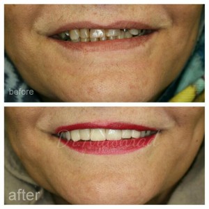 لمینیت سرامیکی (دندانهای نیش تا نیش) و روکش زیرکونیا(کرسی های کوچک یا پره مولر)
