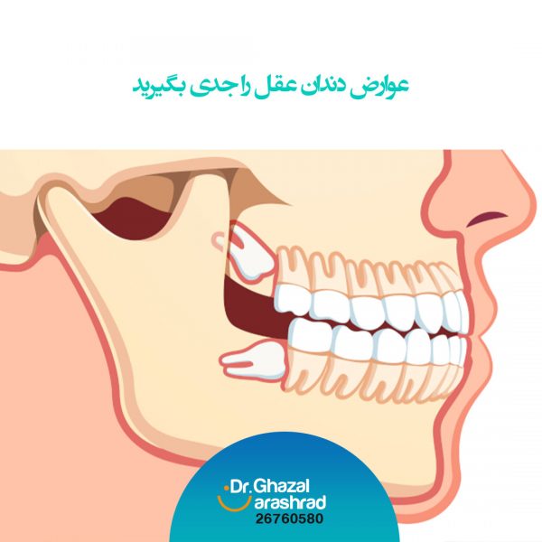 عوارض دندان عقل