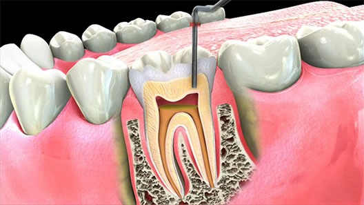 بلیچینگ دندان عصب کشی شده