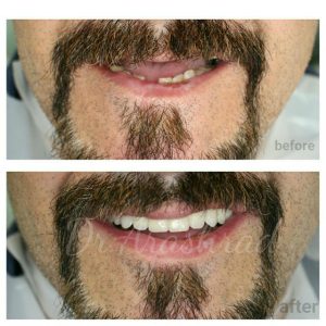 Maxillary full bony anchorage implant supported prosthesis