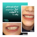 اصلاح فرم دندان لترال با کامپوزیت رنگ A2