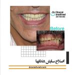 اصلاح سایش دندان ها