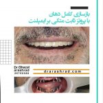 بازسازی کامل دهان با پروتز ثابت متکی بر ایمپلنت